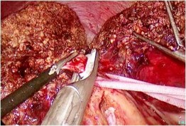 Hình 2 3 Kẹp cuống Glisson phân thùy trước bằng Hem o lok Weck ―Bệnh án 184 BN 7