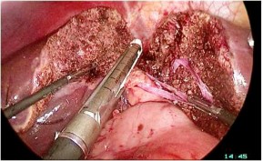 Hình 2 4 Cắt cuống Glisson của gan phải bằng máy Stapler ―Bệnh án 272 BN Nguyễn 8