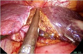 A Các cuống Glisson được cắt bằng stapler B Diện cắt gan 2 2 3 9 Các kỹ thuật 1