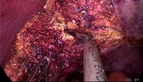 PTNS cắt gan phân thùy sau HPT 6 hay 7 theo Couinaud A Ranh giới giải phẫu của phân 10