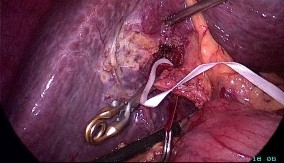 A Cuống Glisson của gan phải B Cắt cuống Glisson gan phải bằng stapler Hình 2 10 11