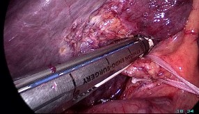 A Cuống Glisson của gan phải B Cắt cuống Glisson gan phải bằng stapler Hình 2 10 12