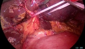 PTNS cắt gan trái A Cuống Glisson của gan trái B Cắt cuống Glisson gan trái bằng 13