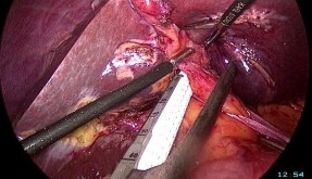 PTNS cắt gan trái A Cuống Glisson của gan trái B Cắt cuống Glisson gan trái bằng 14