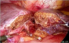 A Các cuống Glisson được cắt bằng stapler B Diện cắt gan 2 2 3 9 Các kỹ thuật 4