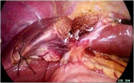 A Các cuống Glisson của HPT 4 B Ranh giới giải phẫu của HPT 4 Hình 2 7 PTNS cắt gan 5