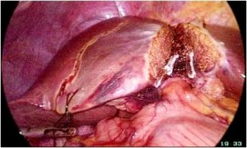 A Các cuống Glisson của HPT 4 B Ranh giới giải phẫu của HPT 4 Hình 2 7 PTNS cắt gan 6