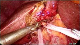 A Cuống Glisson của phân thùy trước B Ranh giới giải phẫu của phân thùy trước 7