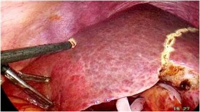 A Cuống Glisson của phân thùy trước B Ranh giới giải phẫu của phân thùy trước 8