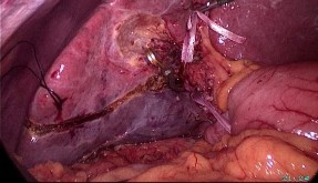 PTNS cắt gan phân thùy sau HPT 6 hay 7 theo Couinaud A Ranh giới giải phẫu của phân 9