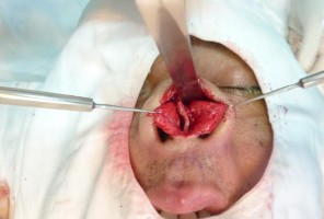 Hình 3 2 Đường mổ hở bộc lộ toàn bộ sụn mũi bên và vách ngăn Lấy sụn 6