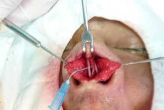 Hình 3 3 Đặt mảnh ghép SG và SG hình L vào đúng vị trí dùng kim cố định Hình 1