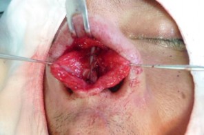 Hình 3 4 Khâu cố định mảnh ghép SG và SG hình L vào vách ngăn sụn cánh mũi bên 2