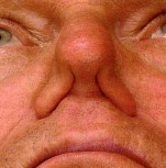 Hình 1 4 Hẹp van mũi 2 bên Sụp thành mũi hai bên khi hít vào Nguồn Charles G Hurbis 2