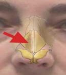 Hình 1 5 Hẹp van mũi phải Sụp thành mũi bên phải khi hít vào Nguồn Charles G 3