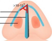 Góc này được duy trì bởi mối tương quan liên kết giữa vách ngăn sụn mũi bên 1