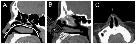 Hình 1 12 Hình tái tạo trên CT scan để đo góc van mũi trong A trục đường thông 2