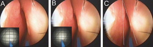 Hình 1 13 Đo góc van mũi trong qua nội soi Nguồn Myung Whan Suh 2005 79 Kết quả góc 3