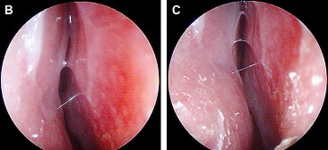 Hình 1 15 Hình ảnh van mũi trước B và sau C khi làm nghiệm pháp Cottle Nguồn Robert 3