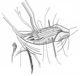 Sụn mũi bên trên Vách ngăn Spreader graft Xương mũi Sụn cánh mũi dưới Kim cố 1