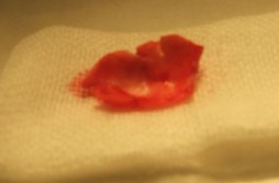 Hình 1 27 Sụn vành tai lấy từ mặt sau Hình 1 28 Sụn vành tai sau khi lấy 1 4 3 3 10