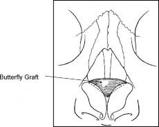 Hình 1 20 Cách đặt và cố định BG Nguồn D Heath Stacey 2009 30 1 4 2 3 ABG Alar Batten 2