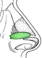 Hình 1 21 Cách đặt và cố định ABG Nguồn Daniel G Becker 2003 27 1 4 2 4 CSG Columellar 3