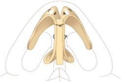 Hình 1 22 Cách đặt và cố định CSG Nguồn John S Rhee 2010 54 1 4 3 Nguyên liệu tạo 4