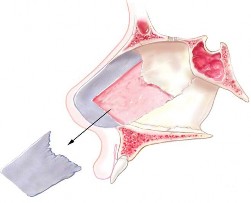 Hình 1 23 Vị trí lấy sụn tứ giác và phần sụn hình chữ L còn để lại Nguồn 5