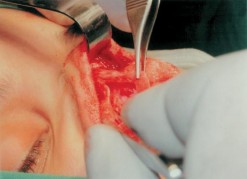 Hình 1 24 Sụn vách ngăn được để lại phần trên và trước hình chữ L Nguồn 6