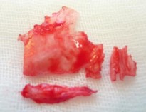 Hình 1 25 Sụn vách ngăn sau khi được lấy 1 4 3 2 Sụn vành tai Sụn vành tai có 7