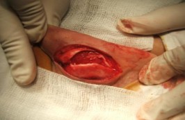 Hình 1 27 Sụn vành tai lấy từ mặt sau Hình 1 28 Sụn vành tai sau khi lấy 1 4 3 3 9