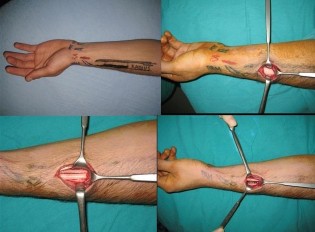 Hình 1 30 Mảnh ghép được lấy từ xương cẳng tay Nguồn Yakup Cil 2011 138 Hình 1 1