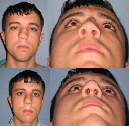 Hình 1 32 Hình bệnh nhân trước và sau mổ Nguồn Yakup Cil 2011 138 1 5 2 2 Taha Z 3