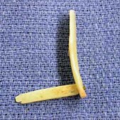 Hình 1 33 Mảnh ghép được tạo hình từ xương sọ cố định giữa 2 phần bằng 4