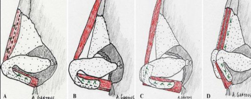 Hình 1 36 Các phương pháp đặt mảnh ghép A Mảnh ghép sống mũi dưới xương 5