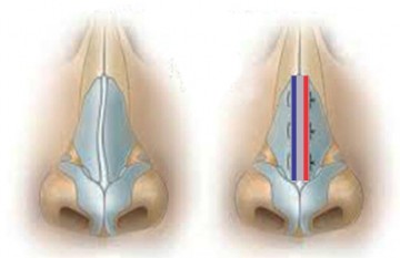 Hình 2 6 Đặt mảnh ghép SG và SG cải tiến hình chữ L khâu cố định Hình 2 7 10