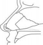 Hình 2 2 Sơ đồ ghi nhận phương pháp phẫu thuật Xác định nguyên nhân gây hẹp 2