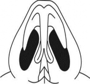 Hình 2 2 Sơ đồ ghi nhận phương pháp phẫu thuật Xác định nguyên nhân gây hẹp 4