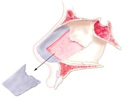 Hình 2 4 Lấy sụn tứ giác từ vách ngăn tạo mảnh ghép Hình 2 5 Tạo hình mảnh 7