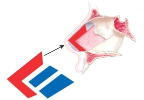 Hình 2 5 Tạo hình mảnh ghép SG cải tiến hình chữ L từ sụn vách ngăn và vị 8