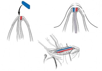 Hình 2 6 Đặt mảnh ghép SG và SG cải tiến hình chữ L khâu cố định Hình 2 7 9