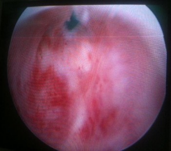 Hình 3 20 Nội soi chẩn đoán phát hiện hẹp cổ bàng quang ― Nguồn Phan Văn C 1935 1