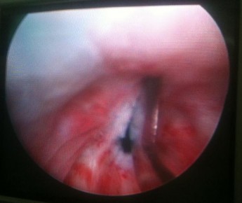 Hình 3 21 Nội soi điều trị xẻ rộng cổ bàng quang ― Nguồn Phan Văn C 1935 số 2