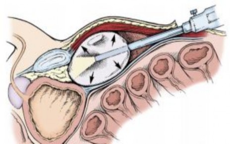 Hình 1 4 Tạo khoang ngoài phúc mạc Nguồn Li Ming Su 2012 Campbell Walsh Urology 56 1 5 6 3 2