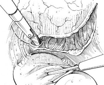 Hình 1 5 Phẫu thuật nội soi qua phúc mạc Nguồn Michael D Fabrizio 2004 Glenn 39 s 1
