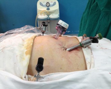 Hình 2 8 Đặt 4 trocar theo hình cánh quạt dưới rốn ― Nguồn Lương Văn T 1954 3