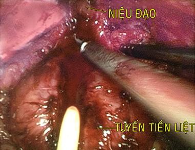 Hình 2 9 Phẫu thuật nội soi cắt tuyến tiền liệt ngược dòng Niệu đạo cắt 4