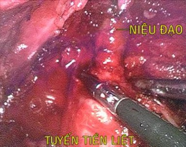 Hình 2 10 Phẫu thuật nội soi cắt tuyến tiền liệt xuôi dòng Niệu đạo cắt sau 5