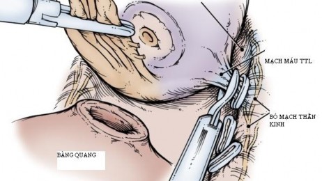 Hình 2 11 Kỹ thuật bảo tồn bó mạch thần kinh trong phẫu thuật nội soi Nguồn 1